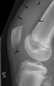 Joint effusion 1