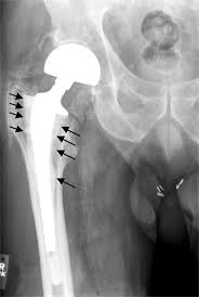 joint replacement