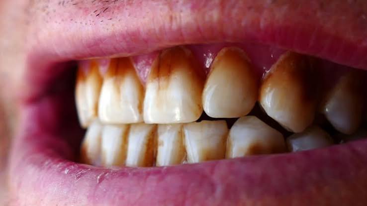 أعراض خراج الأسنان